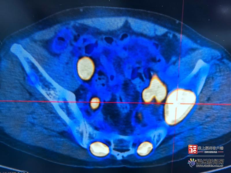 福建首例PSMA靶向放射性配体治疗落地，晚期前列腺癌患者新希望(图2)